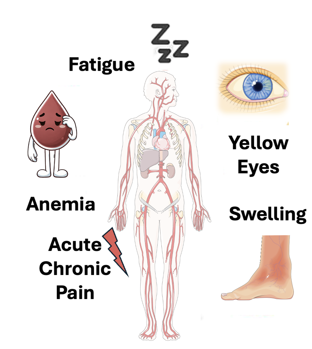 Listing some of the symptoms of sickle cell disease with illustrations. The symptoms include yellow eyes, fatigue, swelling, anemia and acute chronic pain.